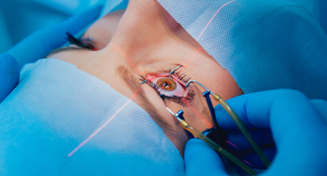 LASIK surgery infographic highlighting steps and recovery expectations